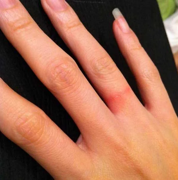 Аллергия на серебряное кольцо: симптомы, причины и лечение