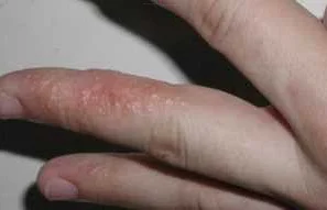 Аллергия на серебряное кольцо: симптомы, причины и лечение
