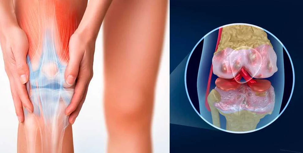 Виды болезненных ощущений в коленном суставе