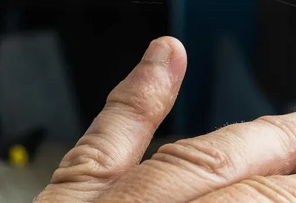 Аллергические водяные прыщики на пальцах рук