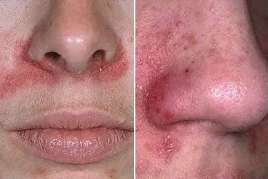 Причины и способы избавления от шелушения около носа