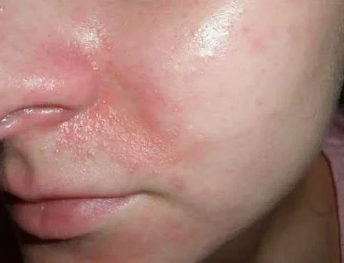Причины и способы избавления от шелушения около носа